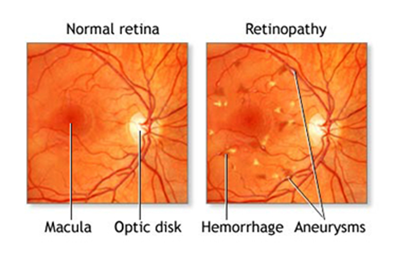 Best Eye Hospital in Bangalore for Retina